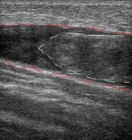 флотирующий тромб