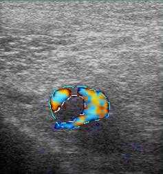 реканализация бедренной вены