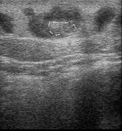 реканализация поверхностной вены