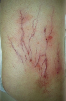 телеангиэктазии