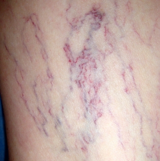 телеангиэктазии