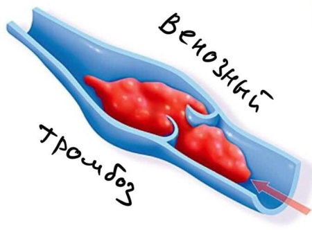 венозный тромбоз